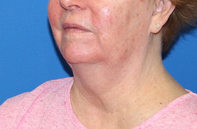 Neck Lift Before & After Gallery - Patient 135194 - Image 3