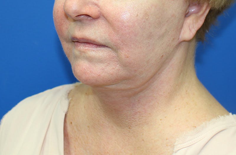 Neck Lift Before & After Gallery - Patient 135194 - Image 4