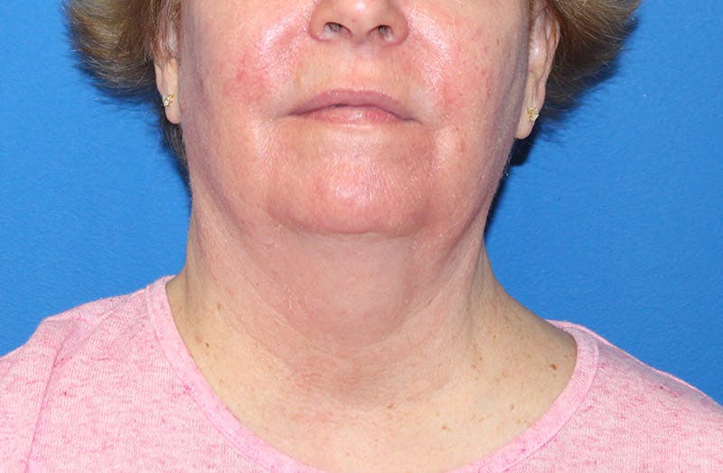 Neck Lift Before & After Gallery - Patient 135194 - Image 5