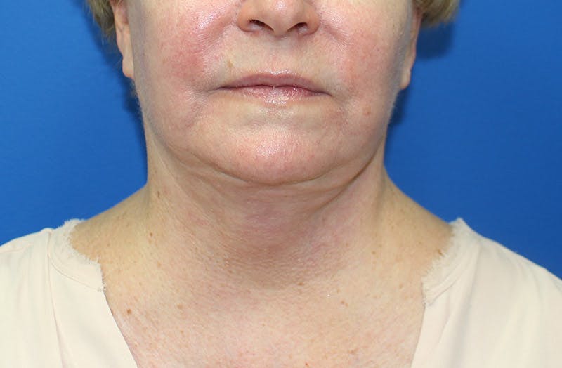 Neck Lift Before & After Gallery - Patient 135194 - Image 6