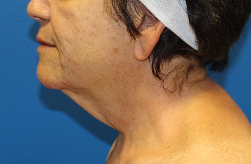 Neck Lift Before & After Gallery - Patient 242968 - Image 1