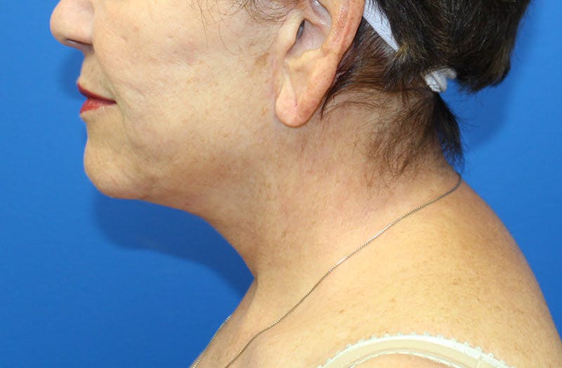 Neck Lift Before & After Gallery - Patient 242968 - Image 2