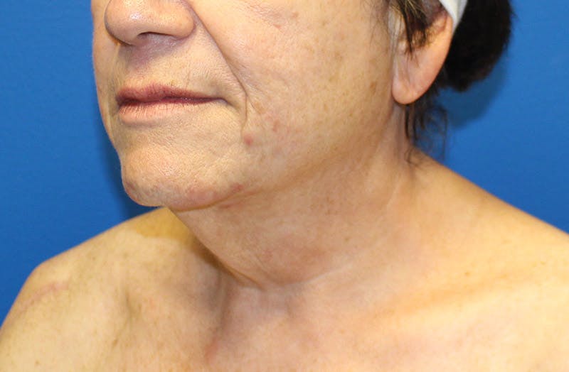 Neck Lift Before & After Gallery - Patient 242968 - Image 3