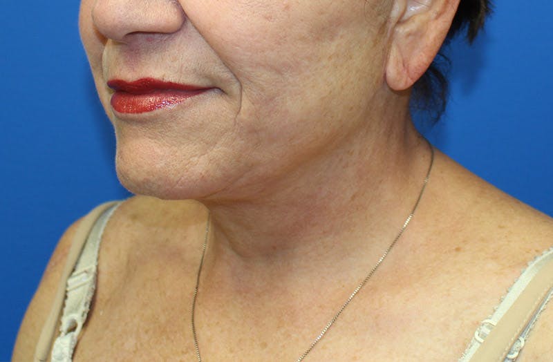 Neck Lift Before & After Gallery - Patient 242968 - Image 4