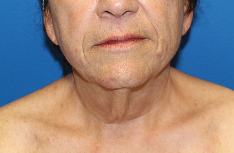 Neck Lift Before & After Gallery - Patient 242968 - Image 5