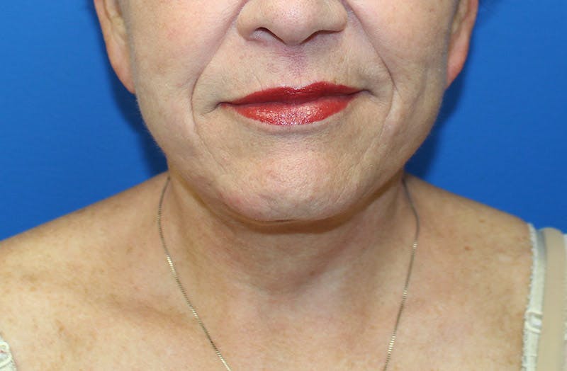 Neck Lift Before & After Gallery - Patient 242968 - Image 6