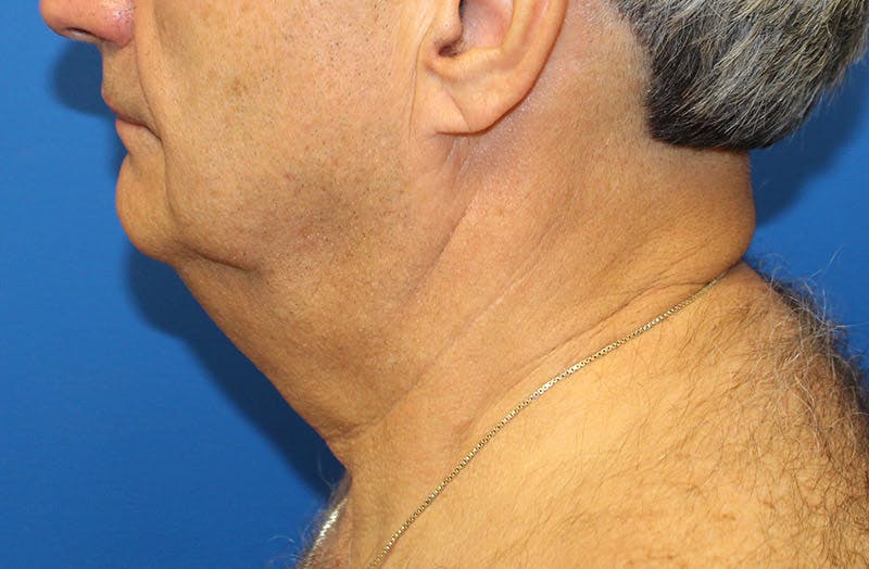 Neck Lift Before & After Gallery - Patient 313213 - Image 1