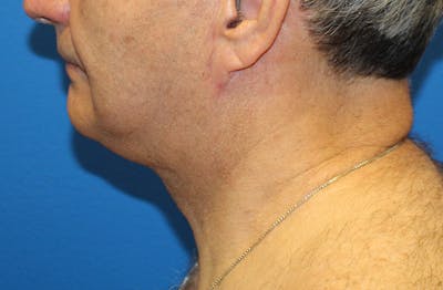 Neck Lift Before & After Gallery - Patient 313213 - Image 2