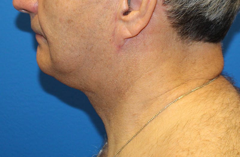 Neck Lift Before & After Gallery - Patient 313213 - Image 2
