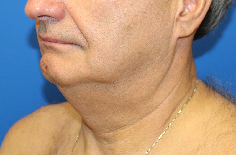 Neck Lift Before & After Gallery - Patient 313213 - Image 3