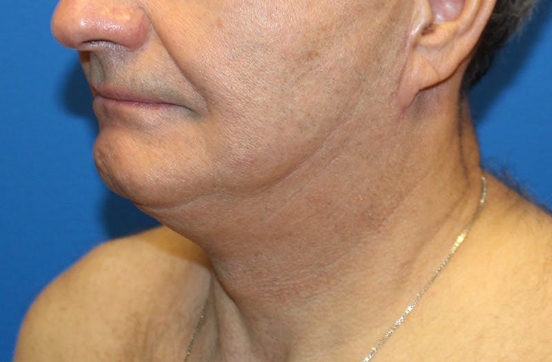 Neck Lift Before & After Gallery - Patient 313213 - Image 4