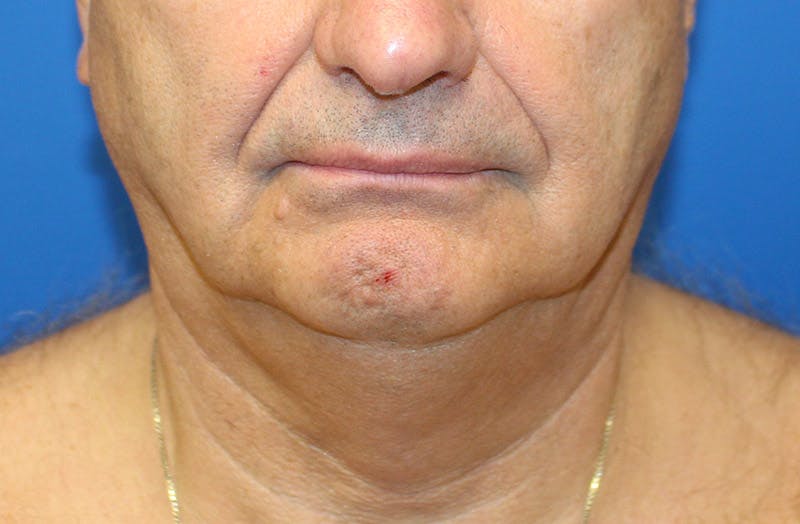 Neck Lift Before & After Gallery - Patient 313213 - Image 5