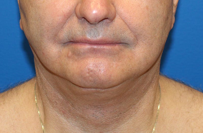 Neck Lift Before & After Gallery - Patient 313213 - Image 6