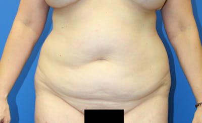 Abdominoplasty Before & After Gallery - Patient 729818 - Image 1