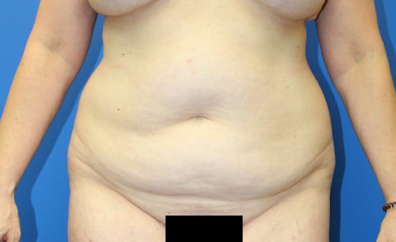 Abdominoplasty Before & After Gallery - Patient 729818 - Image 1