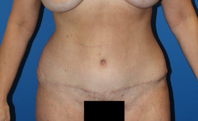 Abdominoplasty Before & After Gallery - Patient 729818 - Image 2