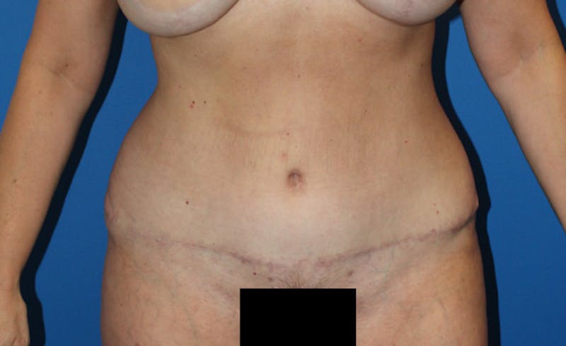 Abdominoplasty Before & After Gallery - Patient 729818 - Image 2