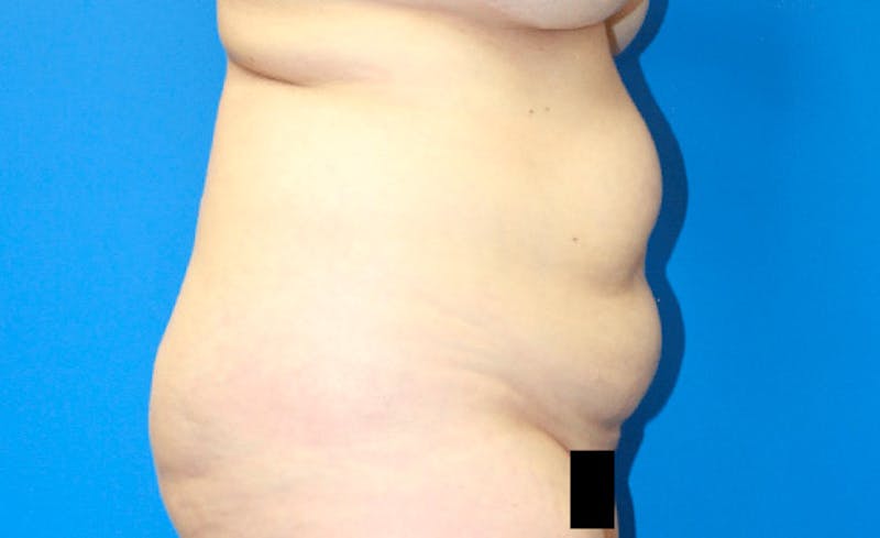 Abdominoplasty Before & After Gallery - Patient 729818 - Image 3