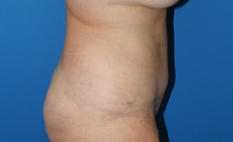 Abdominoplasty Before & After Gallery - Patient 729818 - Image 4