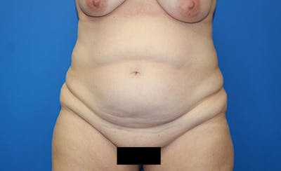 Abdominoplasty Before & After Gallery - Patient 315501 - Image 1