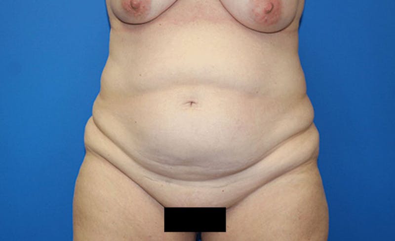 Abdominoplasty Before & After Gallery - Patient 315501 - Image 1