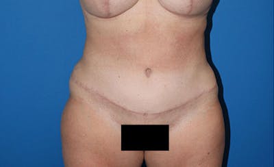 Abdominoplasty Before & After Gallery - Patient 315501 - Image 2