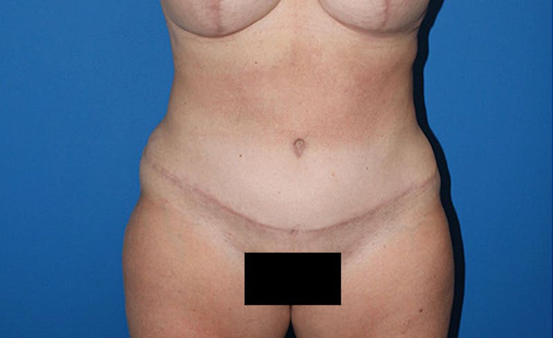 Abdominoplasty Before & After Gallery - Patient 315501 - Image 2