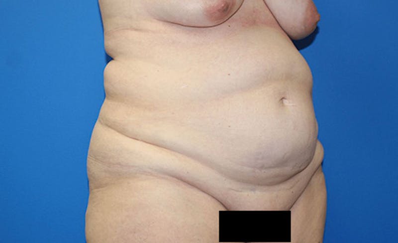Abdominoplasty Before & After Gallery - Patient 315501 - Image 3