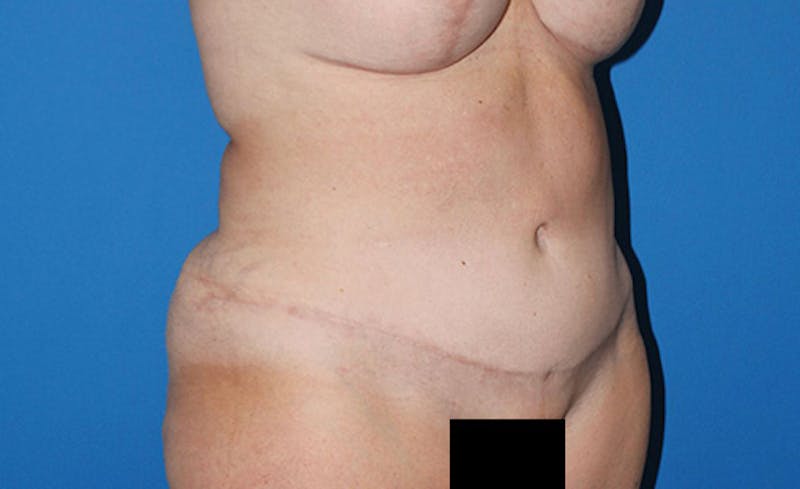 Abdominoplasty Before & After Gallery - Patient 315501 - Image 4