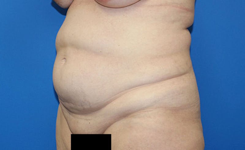 Abdominoplasty Before & After Gallery - Patient 315501 - Image 5