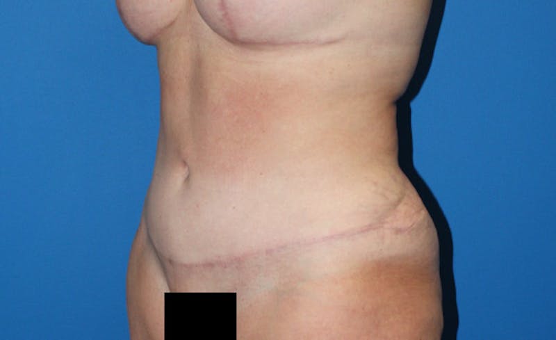 Abdominoplasty Before & After Gallery - Patient 315501 - Image 6