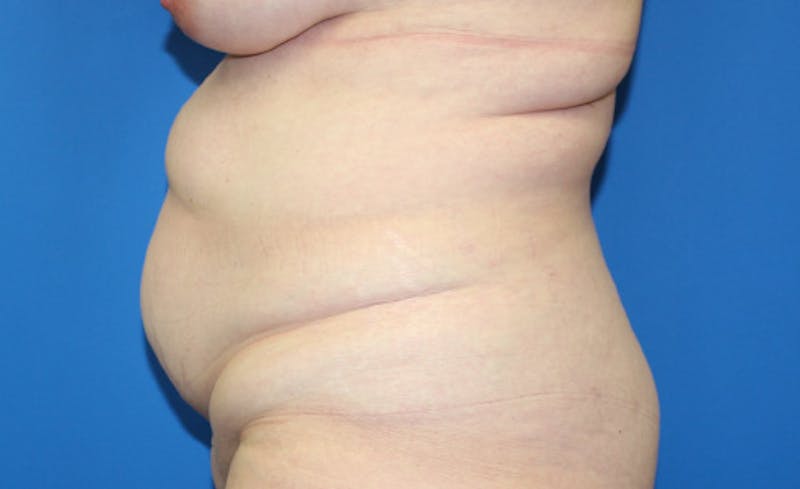 Abdominoplasty Before & After Gallery - Patient 315501 - Image 7