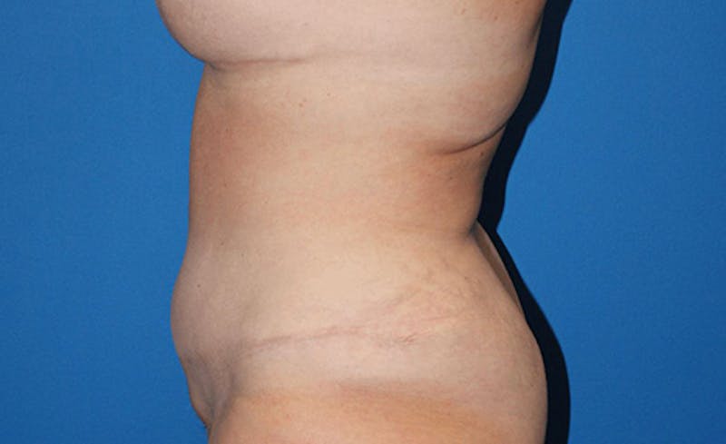 Abdominoplasty Before & After Gallery - Patient 315501 - Image 8