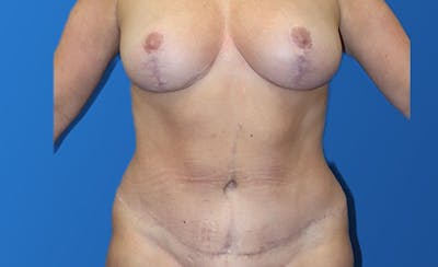 Abdominoplasty Before & After Gallery - Patient 215642 - Image 2