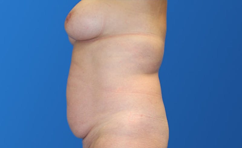 Abdominoplasty Before & After Gallery - Patient 215642 - Image 3