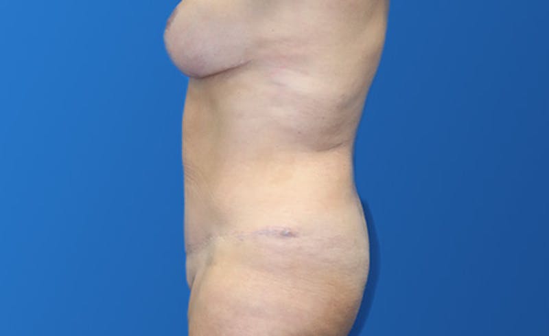 Abdominoplasty Before & After Gallery - Patient 215642 - Image 4