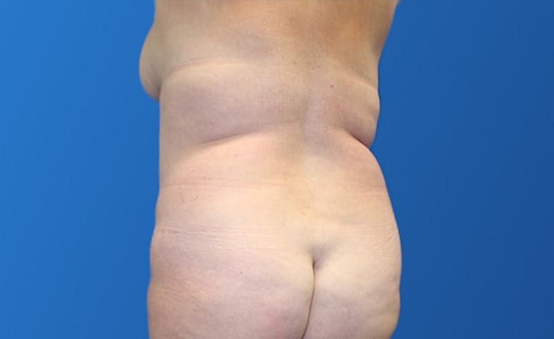 Abdominoplasty Before & After Gallery - Patient 215642 - Image 5