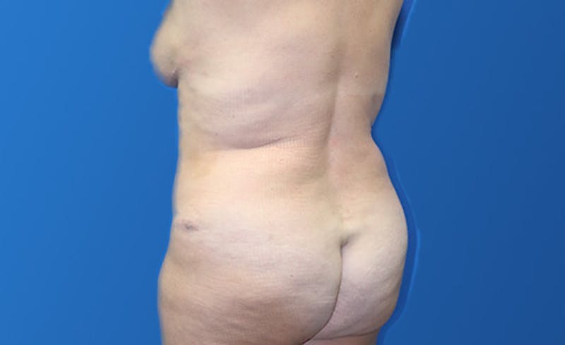 Abdominoplasty Before & After Gallery - Patient 215642 - Image 6