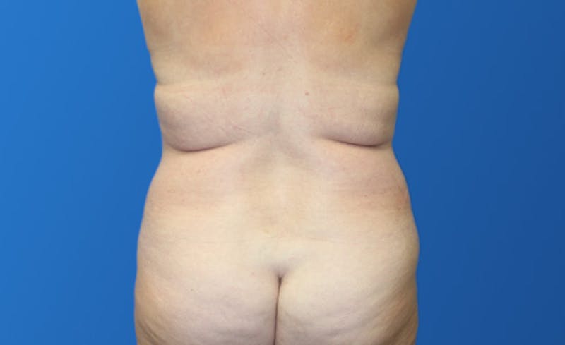Abdominoplasty Before & After Gallery - Patient 215642 - Image 7