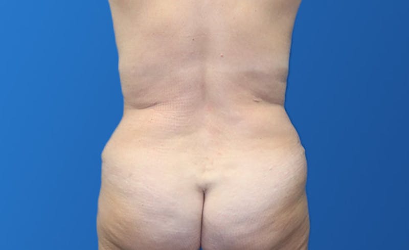 Abdominoplasty Before & After Gallery - Patient 215642 - Image 8