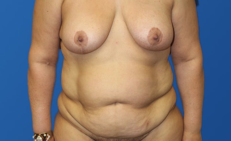 Abdominoplasty Before & After Gallery - Patient 305775 - Image 1