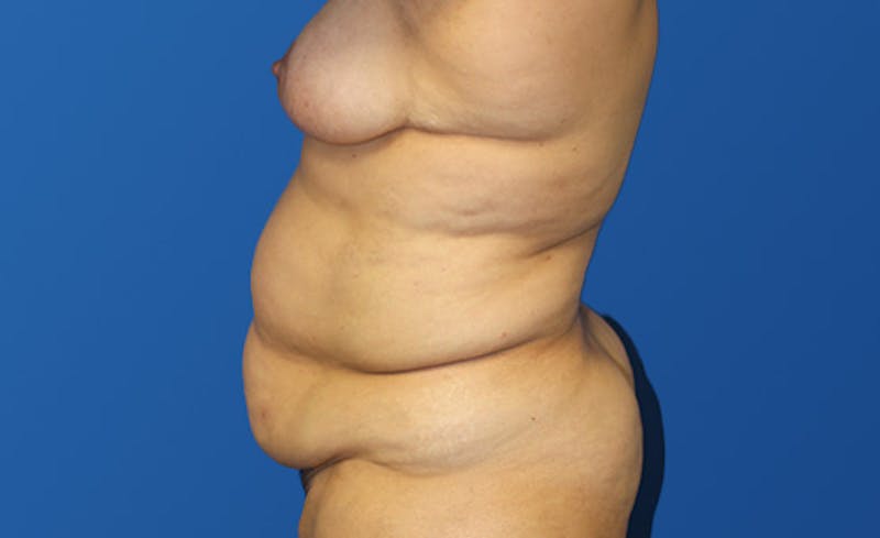 Abdominoplasty Before & After Gallery - Patient 305775 - Image 3