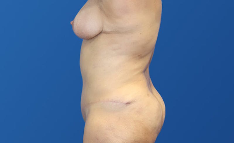 Abdominoplasty Before & After Gallery - Patient 305775 - Image 4