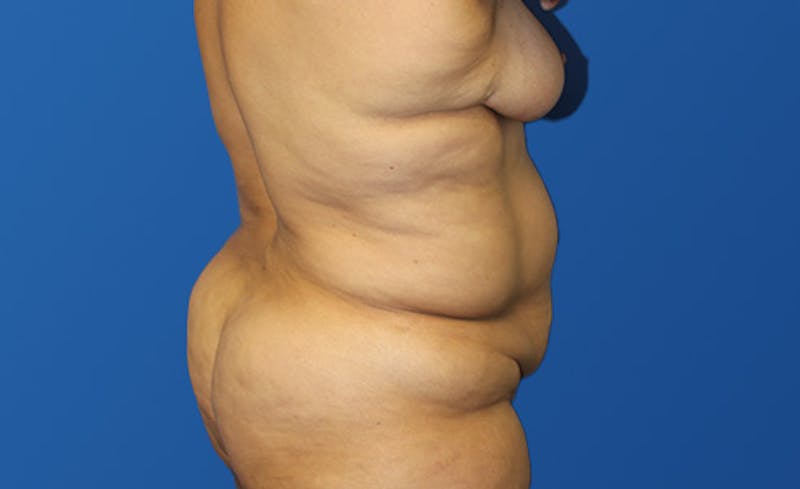 Abdominoplasty Before & After Gallery - Patient 305775 - Image 5