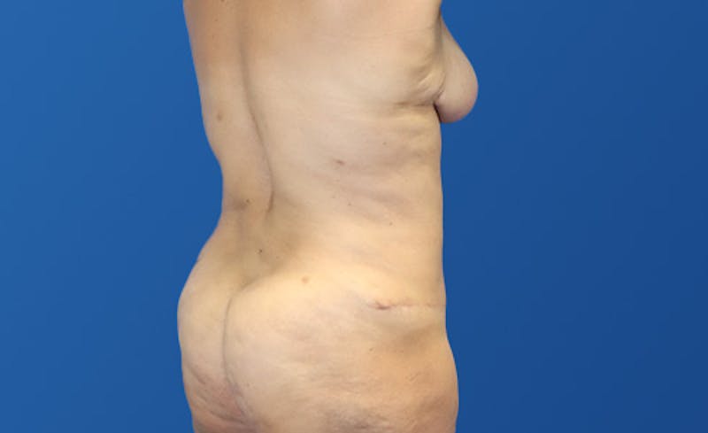 Abdominoplasty Before & After Gallery - Patient 305775 - Image 6