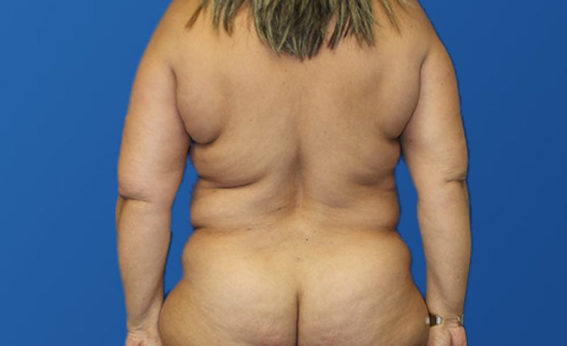Abdominoplasty Before & After Gallery - Patient 305775 - Image 7
