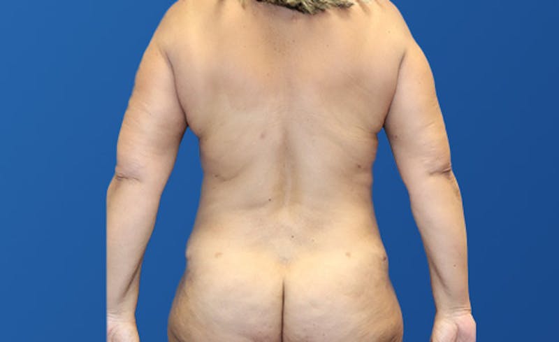 Abdominoplasty Before & After Gallery - Patient 305775 - Image 8