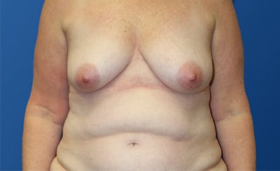 Abdominoplasty Before & After Gallery - Patient 280932 - Image 1