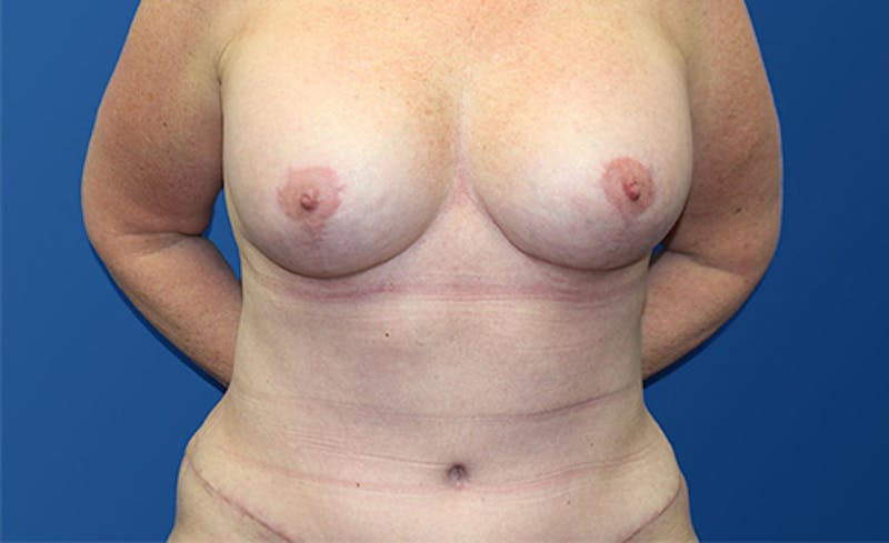 Abdominoplasty Before & After Gallery - Patient 280932 - Image 2