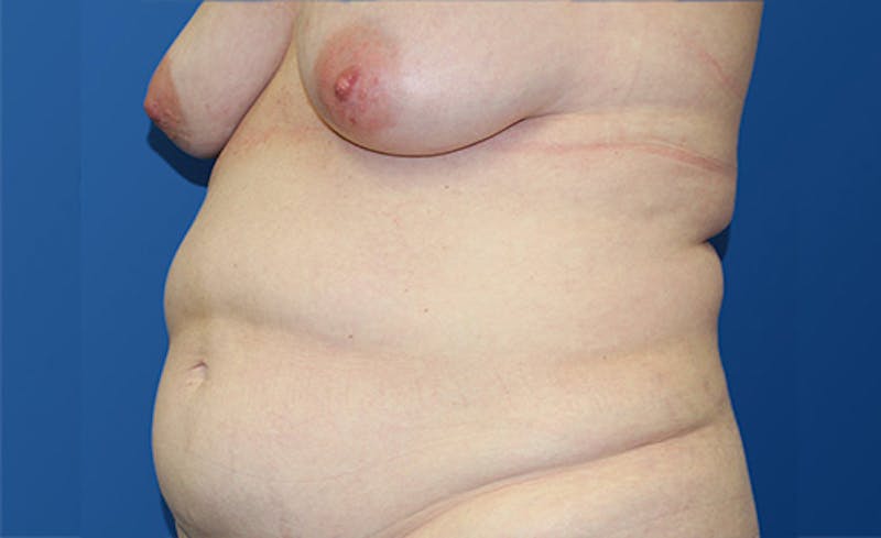 Abdominoplasty Before & After Gallery - Patient 280932 - Image 3